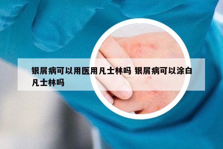 银屑病可以用医用凡士林吗 银屑病可以涂白凡士林吗