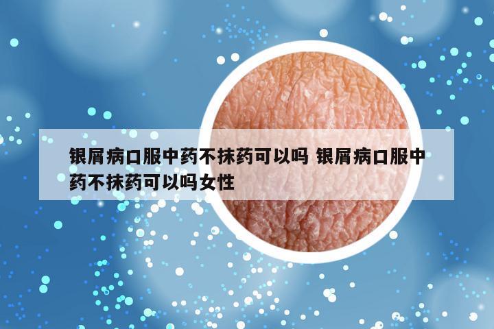 银屑病口服中药不抹药可以吗 银屑病口服中药不抹药可以吗女性