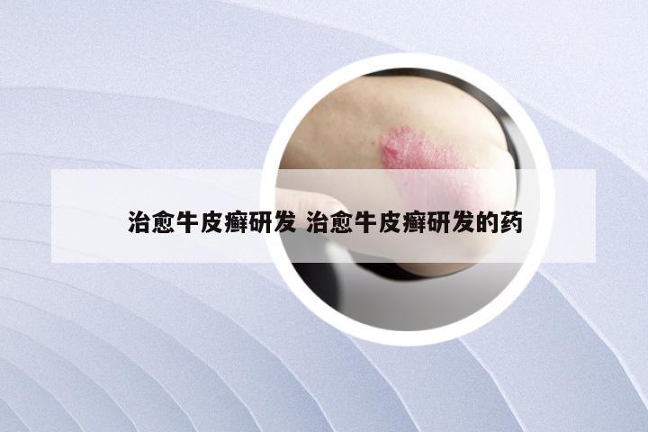 治愈牛皮癣研发 治愈牛皮癣研发的药