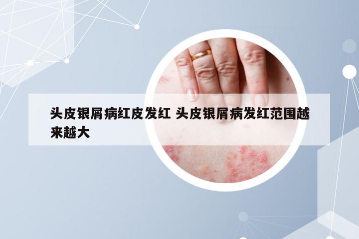 头皮银屑病红皮发红 头皮银屑病发红范围越来越大