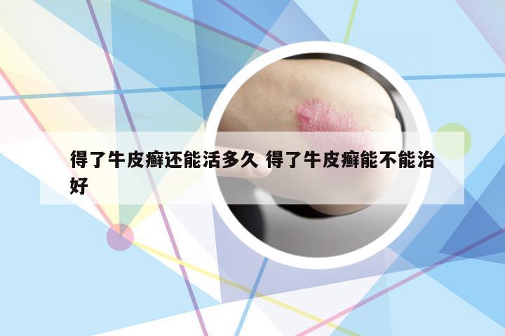 得了牛皮癣还能活多久 得了牛皮癣能不能治好