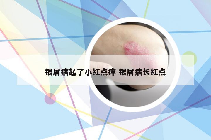 银屑病起了小红点痒 银屑病长红点