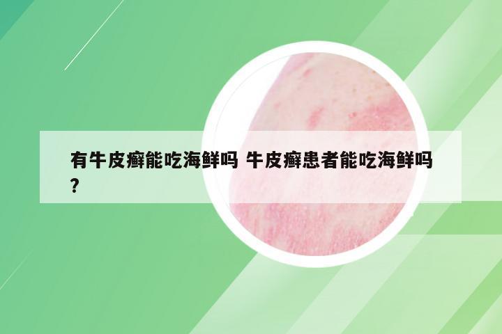 有牛皮癣能吃海鲜吗 牛皮癣患者能吃海鲜吗?