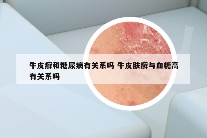 牛皮癣和糖尿病有关系吗 牛皮肤癣与血糖高有关系吗