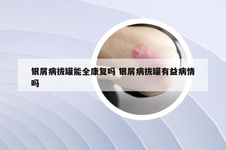 银屑病拔罐能全康复吗 银屑病拔罐有益病情吗