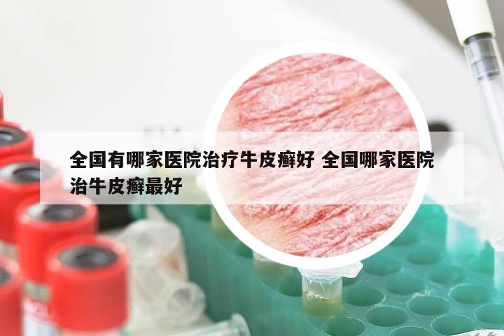 全国有哪家医院治疗牛皮癣好 全国哪家医院治牛皮癣最好