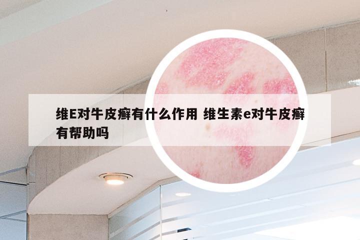 维E对牛皮癣有什么作用 维生素e对牛皮癣有帮助吗
