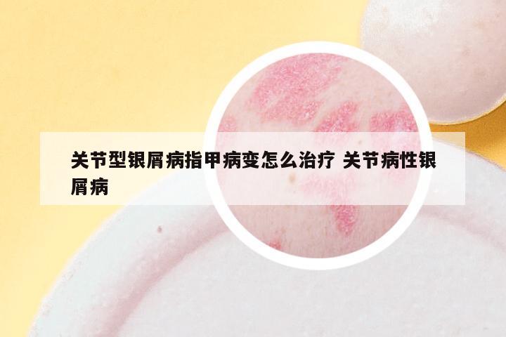 关节型银屑病指甲病变怎么治疗 关节病性银屑病