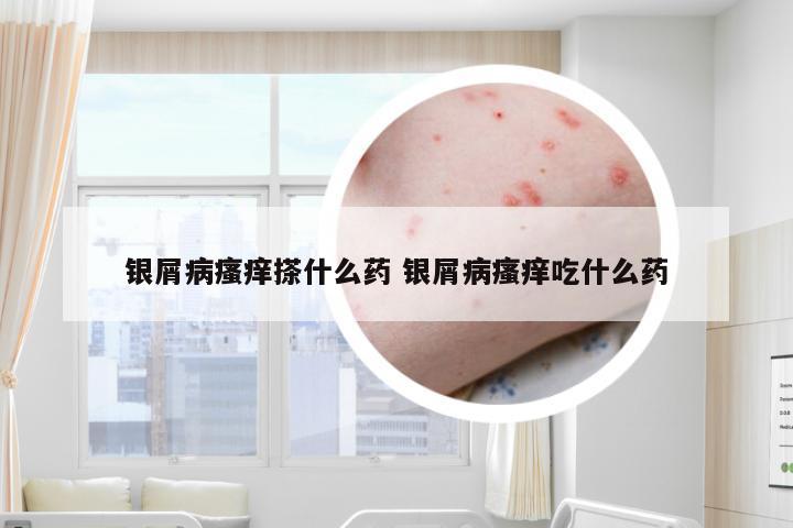 银屑病瘙痒搽什么药 银屑病瘙痒吃什么药