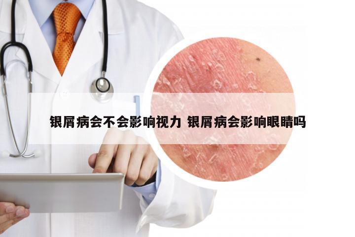 银屑病会不会影响视力 银屑病会影响眼睛吗