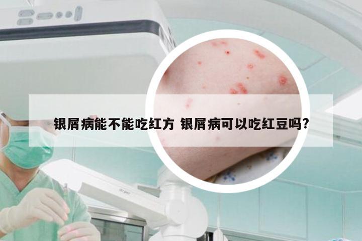 银屑病能不能吃红方 银屑病可以吃红豆吗?