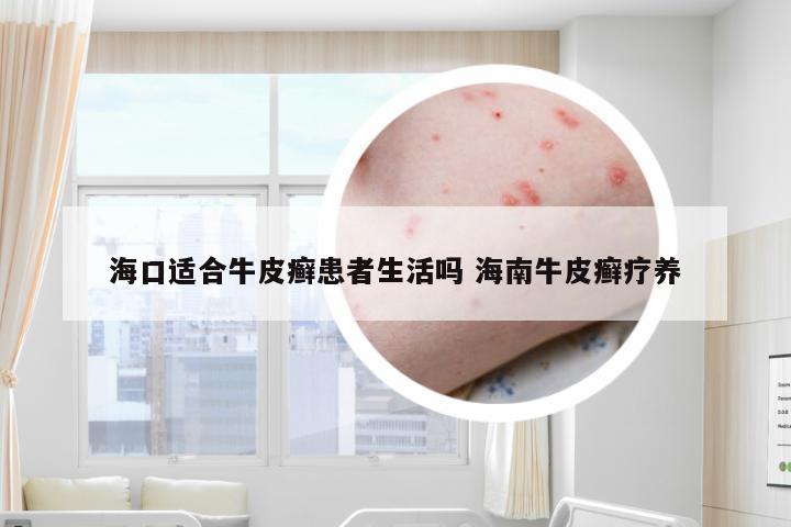 海口适合牛皮癣患者生活吗 海南牛皮癣疗养