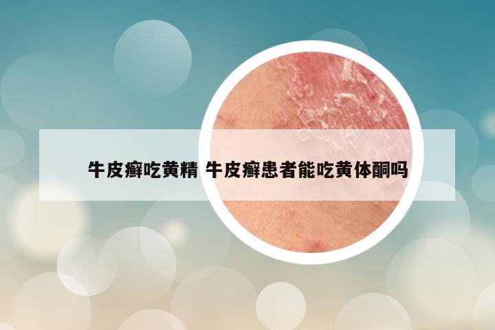 牛皮癣吃黄精 牛皮癣患者能吃黄体酮吗