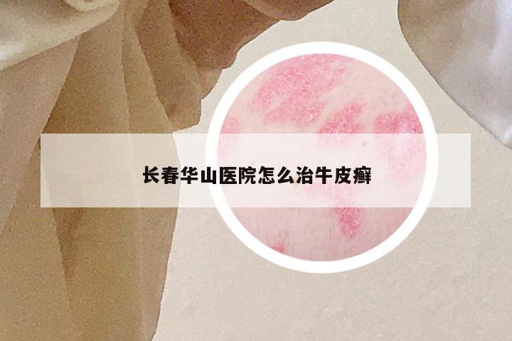 长春华山医院怎么治牛皮癣