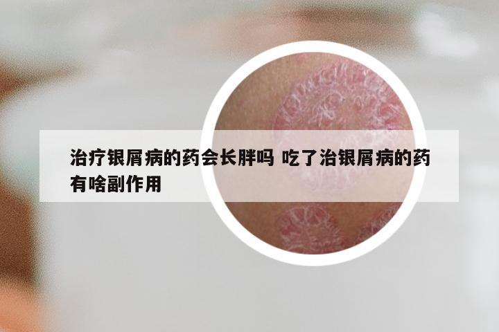 治疗银屑病的药会长胖吗 吃了治银屑病的药有啥副作用