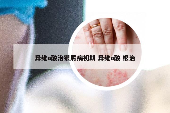 异维a酸治银屑病初期 异维a酸 根治