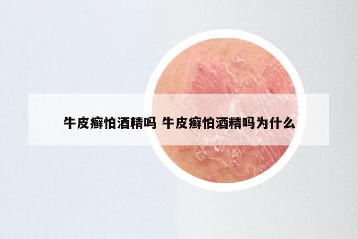 牛皮癣怕酒精吗 牛皮癣怕酒精吗为什么