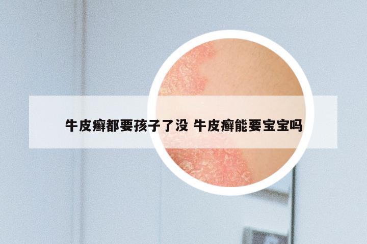 牛皮癣都要孩子了没 牛皮癣能要宝宝吗