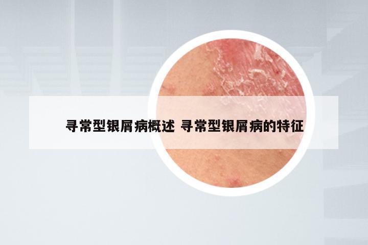 寻常型银屑病概述 寻常型银屑病的特征
