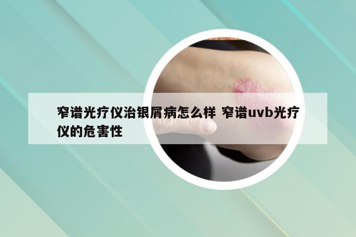 窄谱光疗仪治银屑病怎么样 窄谱uvb光疗仪的危害性