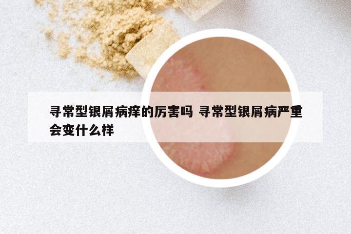 寻常型银屑病痒的厉害吗 寻常型银屑病严重会变什么样