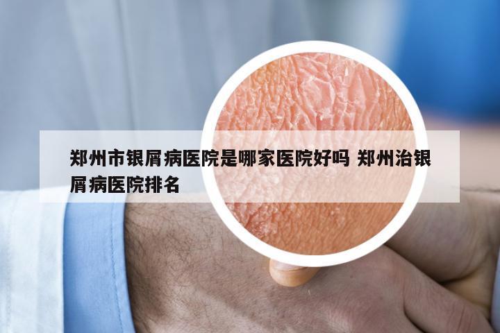 郑州市银屑病医院是哪家医院好吗 郑州治银屑病医院排名