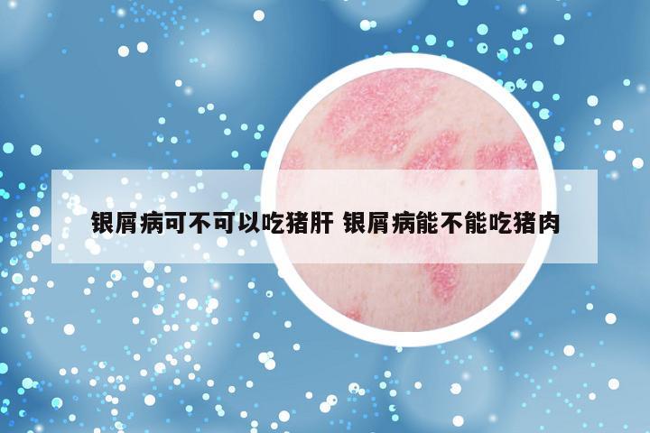 银屑病可不可以吃猪肝 银屑病能不能吃猪肉