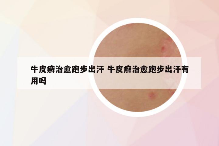 牛皮癣治愈跑步出汗 牛皮癣治愈跑步出汗有用吗