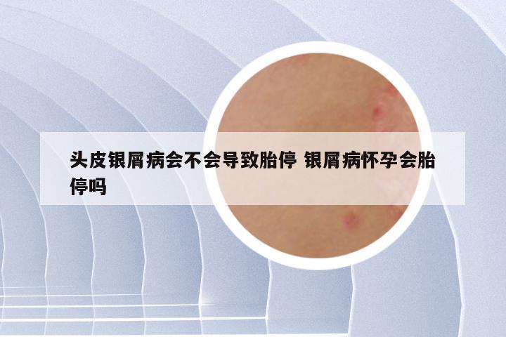 头皮银屑病会不会导致胎停 银屑病怀孕会胎停吗