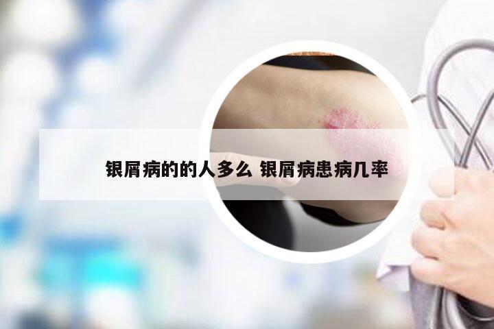 银屑病的的人多么 银屑病患病几率