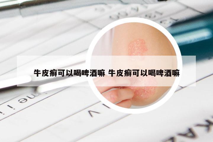牛皮癣可以喝啤酒嘛 牛皮癣可以喝啤酒嘛