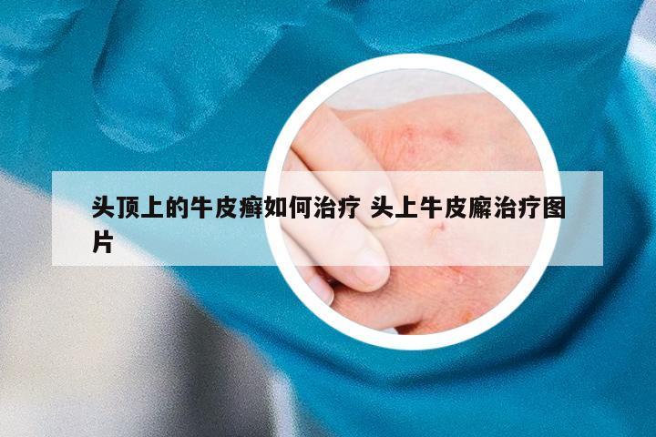头顶上的牛皮癣如何治疗 头上牛皮廨治疗图片