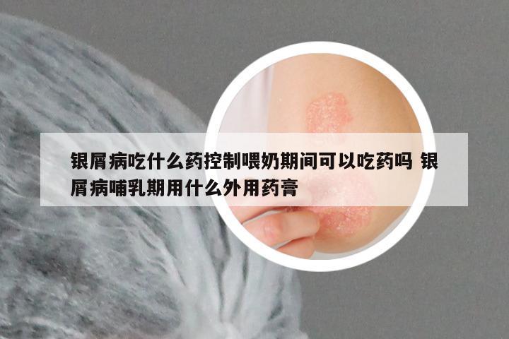银屑病吃什么药控制喂奶期间可以吃药吗 银屑病哺乳期用什么外用药膏