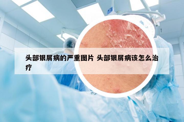头部银屑病的严重图片 头部银屑病该怎么治疗