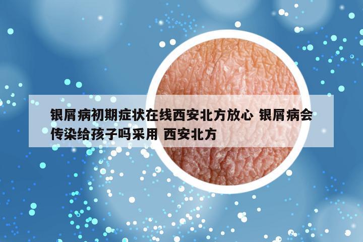 银屑病初期症状在线西安北方放心 银屑病会传染给孩子吗采用 西安北方