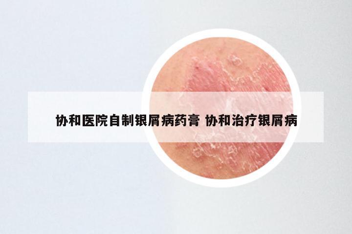 协和医院自制银屑病药膏 协和治疗银屑病