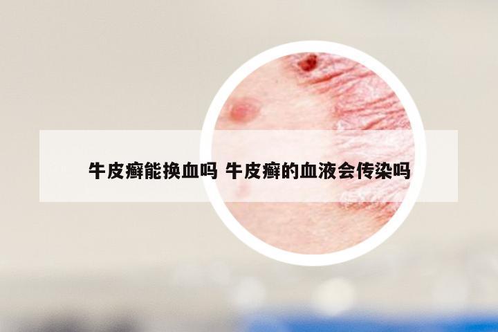 牛皮癣能换血吗 牛皮癣的血液会传染吗