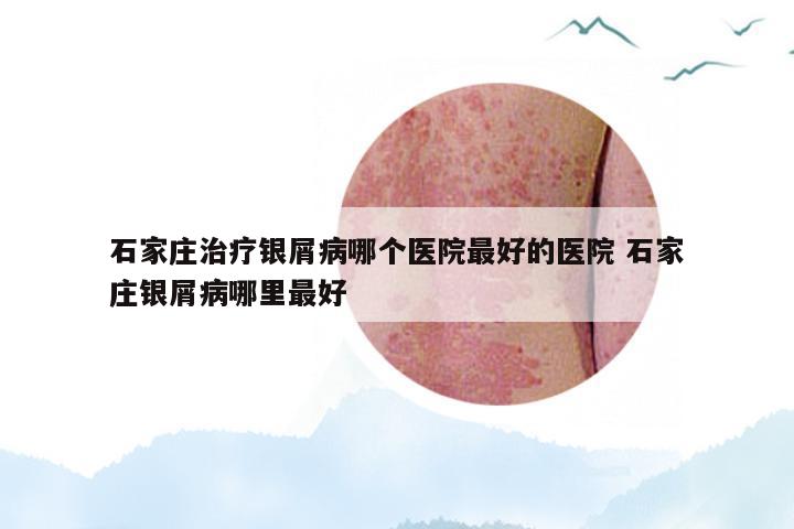 石家庄治疗银屑病哪个医院最好的医院 石家庄银屑病哪里最好