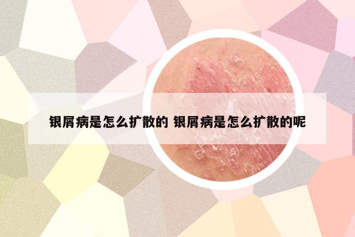 银屑病是怎么扩散的 银屑病是怎么扩散的呢
