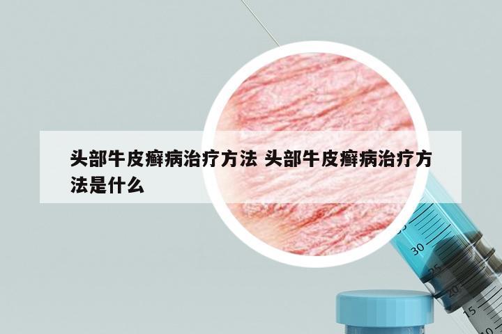 头部牛皮癣病治疗方法 头部牛皮癣病治疗方法是什么
