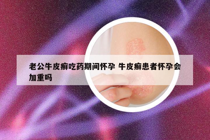 老公牛皮癣吃药期间怀孕 牛皮癣患者怀孕会加重吗
