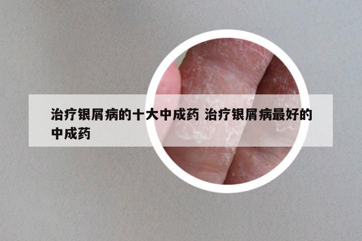 治疗银屑病的十大中成药 治疗银屑病最好的中成药