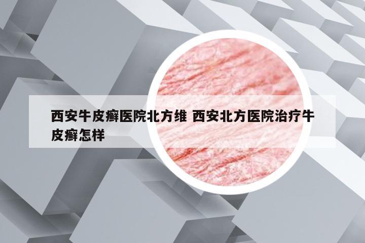 西安牛皮癣医院北方维 西安北方医院治疗牛皮癣怎样