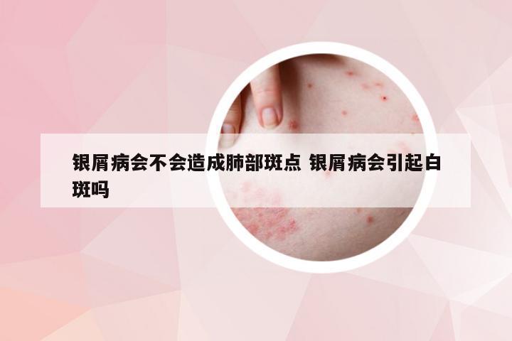 银屑病会不会造成肺部斑点 银屑病会引起白斑吗