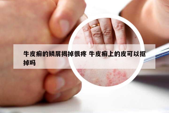 牛皮癣的鳞屑揭掉很疼 牛皮癣上的皮可以抠掉吗