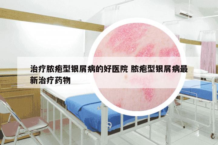 治疗脓疱型银屑病的好医院 脓疱型银屑病最新治疗药物