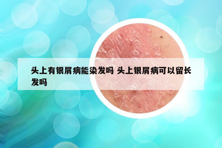 头上有银屑病能染发吗 头上银屑病可以留长发吗