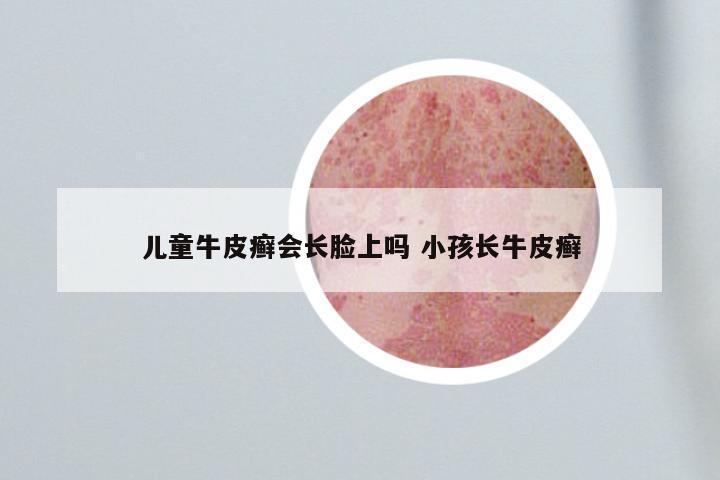 儿童牛皮癣会长脸上吗 小孩长牛皮癣