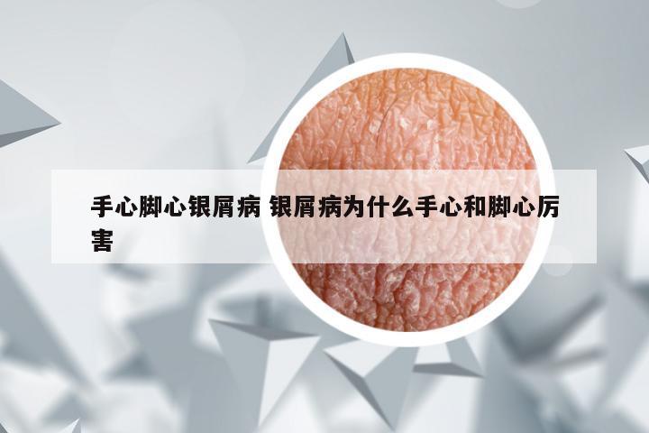 手心脚心银屑病 银屑病为什么手心和脚心厉害