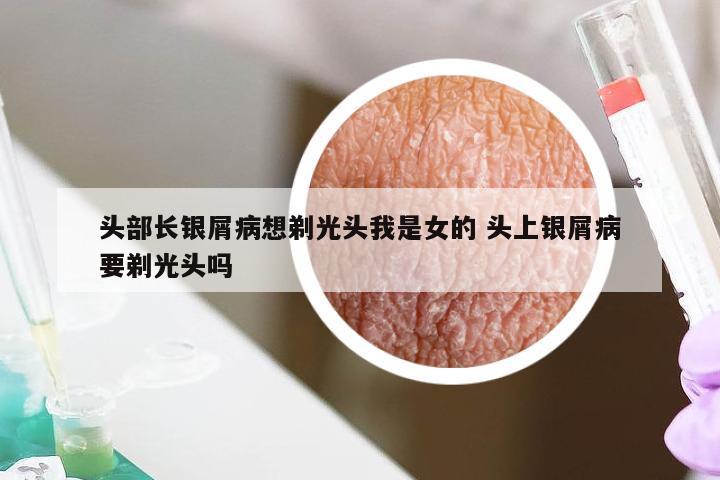 头部长银屑病想剃光头我是女的 头上银屑病要剃光头吗